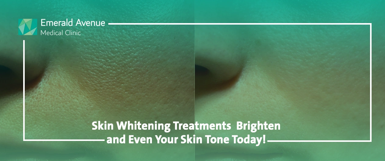 Skin Whitening Treatments