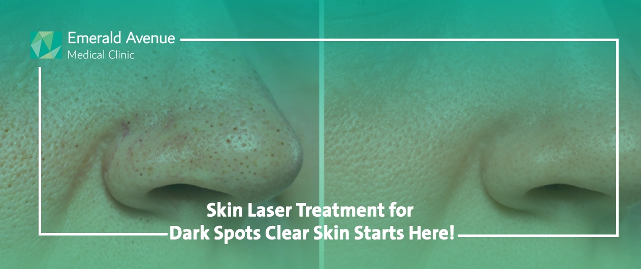 Skin Laser Treatment for Dark Spots